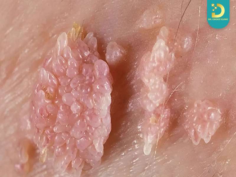 Phòng Khám Điều Trị Sùi Mào Gà Bảo Mật, An Toàn Tại TPHCM 12 Sùi mào gà là gì?