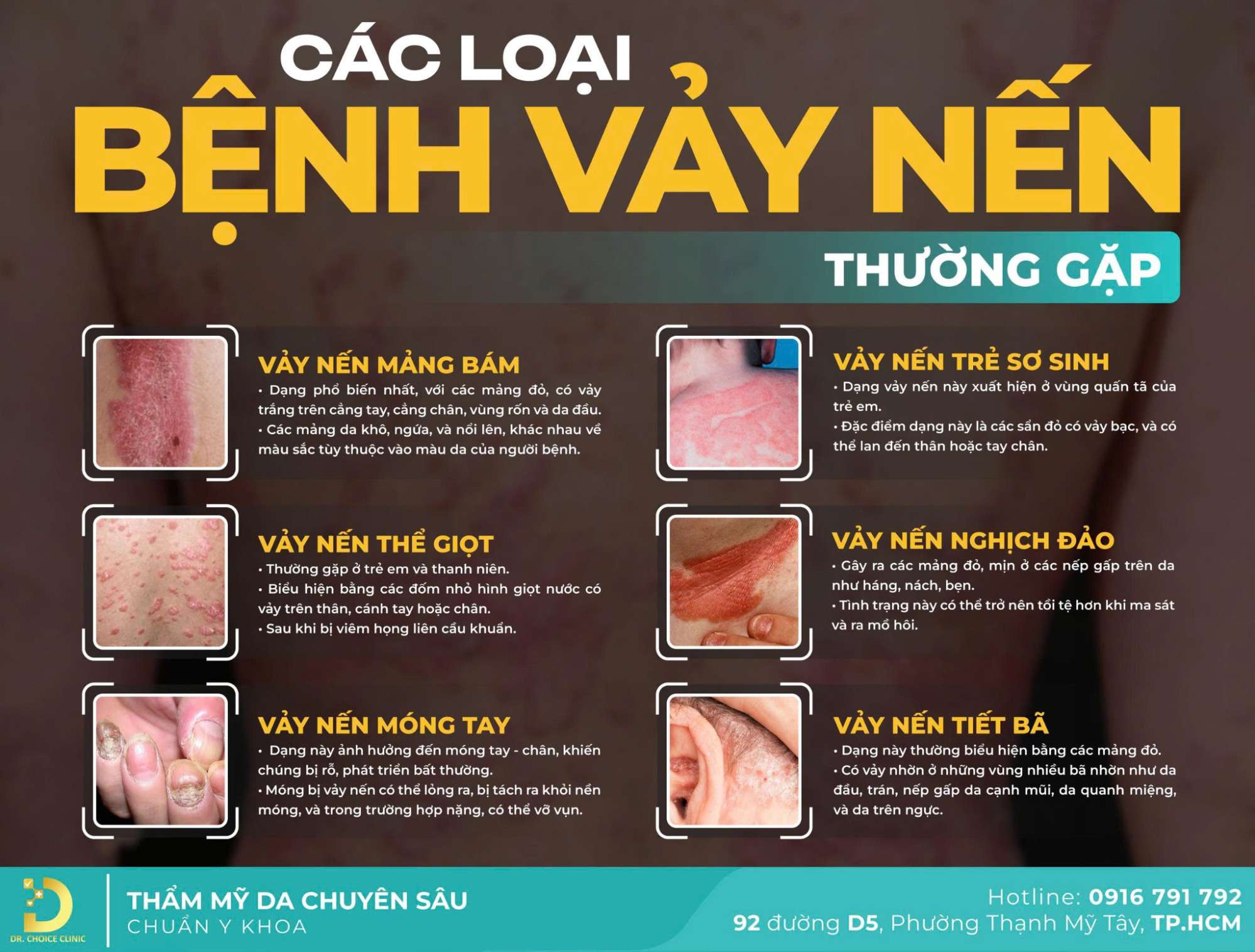 Phòng Khám Điều Trị Vảy Nến An Toàn, Hiệu Quả Tại TPHCM 8 Tổng quan về bệnh vảy nến