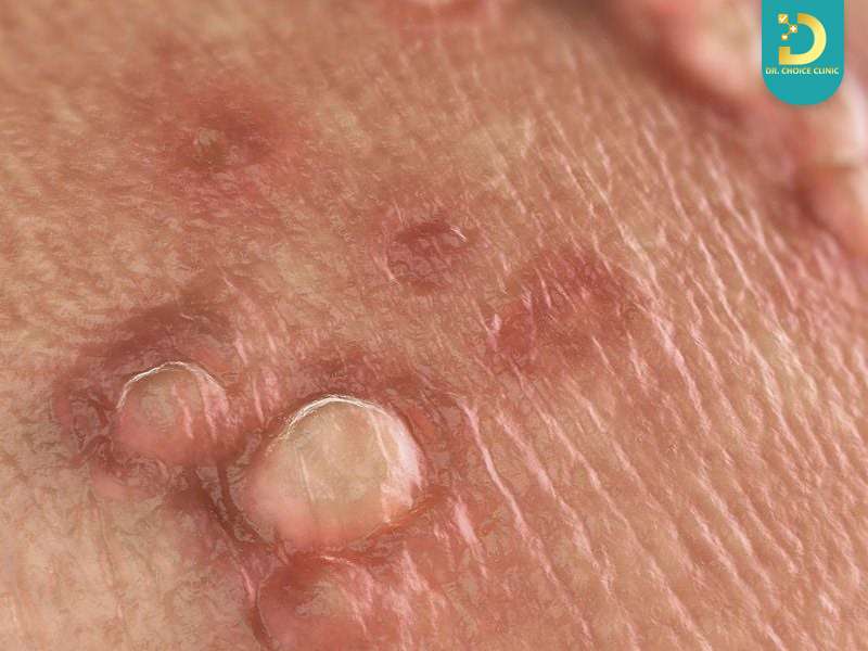 Phòng Khám Điều Trị Sùi Mào Gà Bảo Mật, An Toàn Tại TPHCM 13 Triệu chứng và dấu hiệu nhận biết