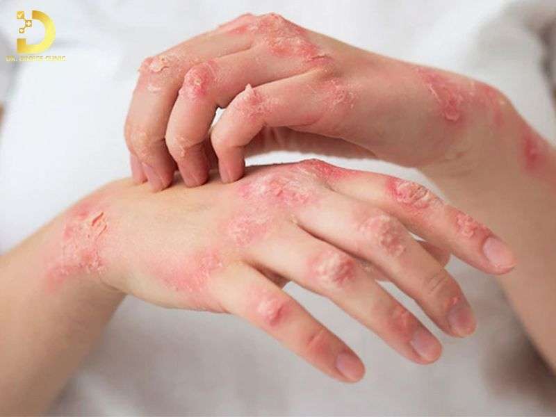 Viêm Da Cơ Địa Bôi Gì, Kiêng Gì? Cách Điều Trị Tại Nhà Hiệu Quả 9 Bệnh viêm da cơ địa là gì và nguyên nhân khởi phát do đâu?
