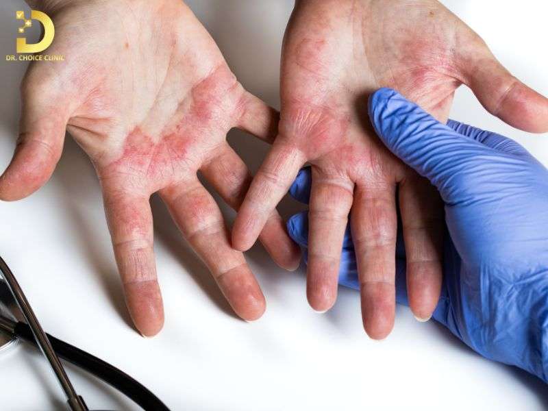 Các Loại Viêm Da Thường Gặp: Cách Phòng Ngừa & Điều Trị Hiệu Quả 10 Các biện pháp phòng ngừa viêm da tái phát hiệu quả là gì?