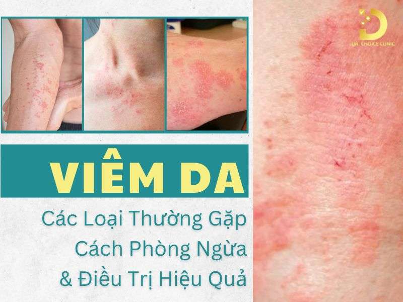 Các Loại Viêm Da Thường Gặp: Cách Phòng Ngừa & Điều Trị Hiệu Quả 8 Các loại viêm da thường gặp