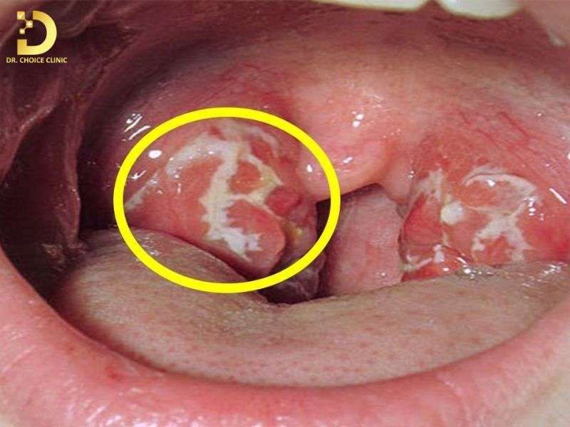 Sùi Mào Gà Trong Họng: Nguyên Nhân, Biểu Hiện & Cách Điều Trị Hiệu Quả 9 Cách phân biệt sùi mào gà với các bệnh lý vùng họng phổ biến