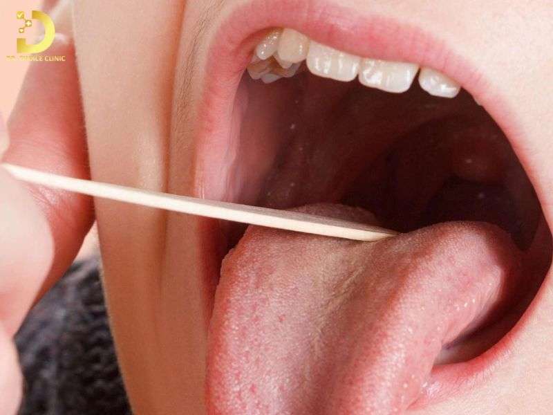 Sùi Mào Gà Trong Họng: Nguyên Nhân, Biểu Hiện & Cách Điều Trị Hiệu Quả 10 Chế độ chăm sóc hậu phẫu và phòng ngừa tái phát sùi mào gà trong họng