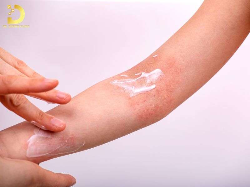 Các Loại Viêm Da Thường Gặp: Cách Phòng Ngừa & Điều Trị Hiệu Quả 12 Chi phí điều trị viêm da và tiêu chí lựa chọn sản phẩm hỗ trợ ra sao?