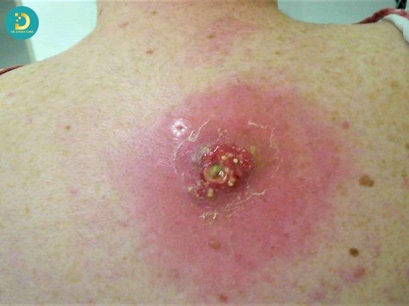 Nhiễm Trùng Da: Nguyên Nhân, Triệu Chứng, Chẩn Đoán & Điều Trị 9 Cơ chế hình thành nhiễm trùng da