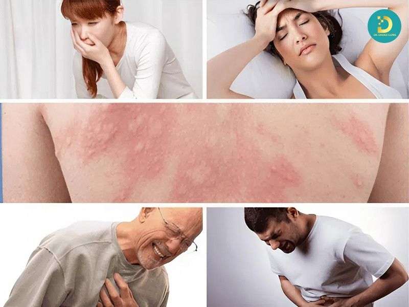 Nổi Mề Đay: Nguyên Nhân, Triệu Chứng & Cách Điều Trị Nhanh Chóng 18 Dấu hiệu nguy hiểm cần đi khám hoặc cấp cứu ngay