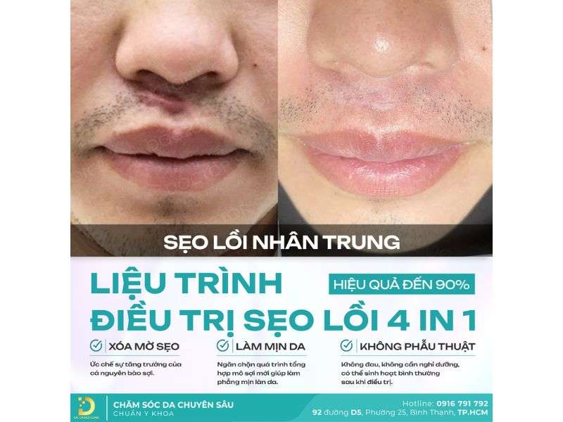 Môi Bị Sẹo Lồi Phải Làm Sao? Nguyên Nhân & Cách Điều Trị Hiệu Quả 19 Địa chỉ nào điều trị sẹo lồi ở môi an toàn, uy tín?