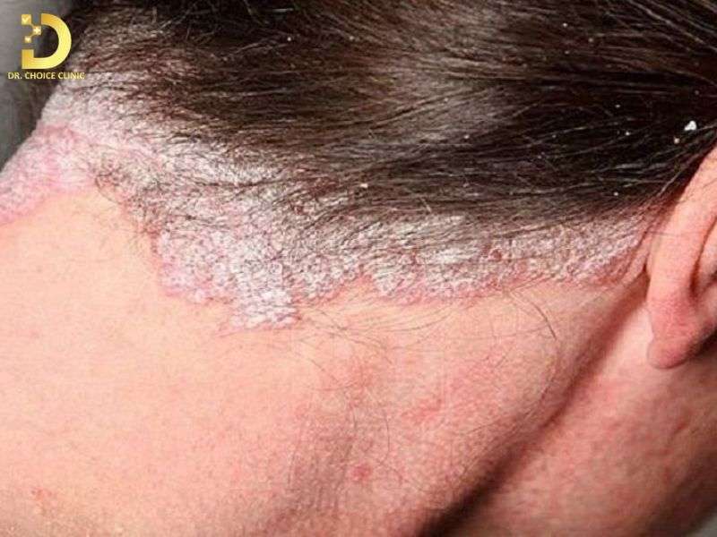 Nấm Da Đầu: Nguyên Nhân, Triệu Chứng & Cách Điều Trị Hiệu Quả 8 Giai đoạn tiến triển: Cơ chế hình thành “Black dot” và Kerion