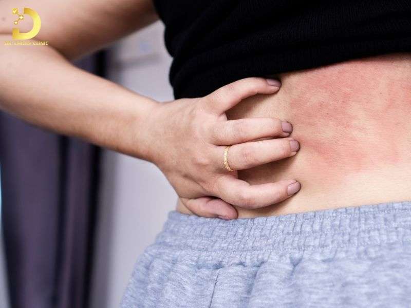 Viêm Da Cơ Địa Bôi Gì, Kiêng Gì? Cách Điều Trị Tại Nhà Hiệu Quả 12 Lưu ý gì khi tự điều trị viêm da cơ địa tại nhà?