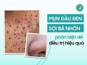 Mụn đầu đen & sợi bã nhờn