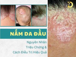 Nấm da đầu