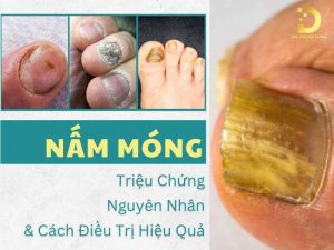 Nấm móng
