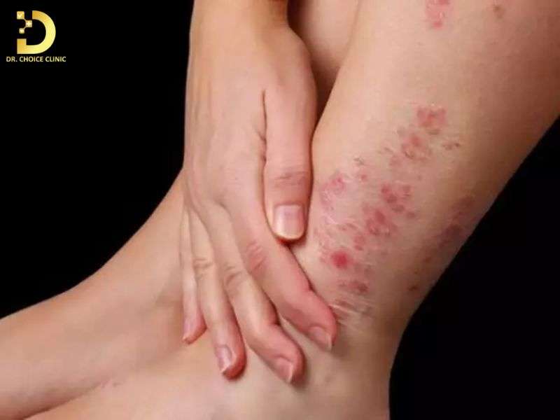 Viêm Da Cơ Địa Bôi Gì, Kiêng Gì? Cách Điều Trị Tại Nhà Hiệu Quả 10 Người bị viêm da cơ địa nên bôi thuốc gì để kiểm soát triệu chứng an toàn?