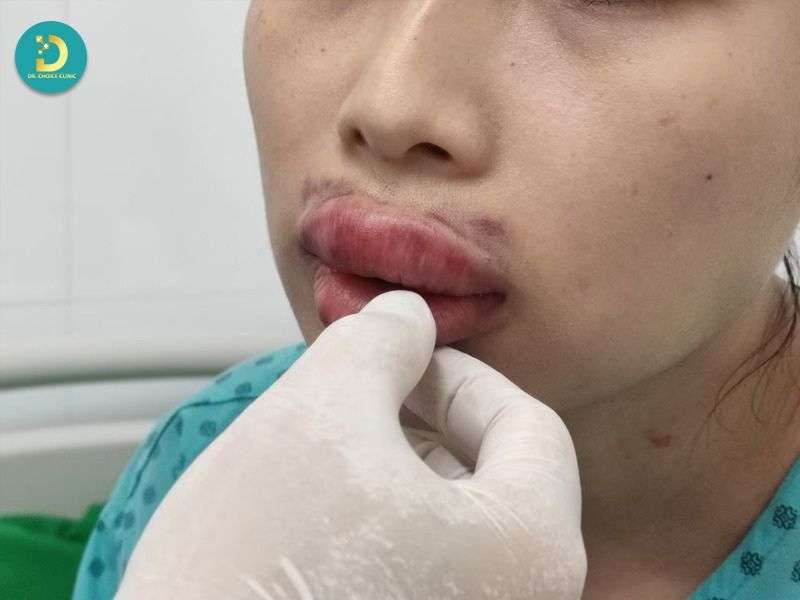 Môi Bị Sẹo Lồi Phải Làm Sao? Nguyên Nhân & Cách Điều Trị Hiệu Quả 13 Nguyên nhân phổ biến gây sẹo lồi ở môi