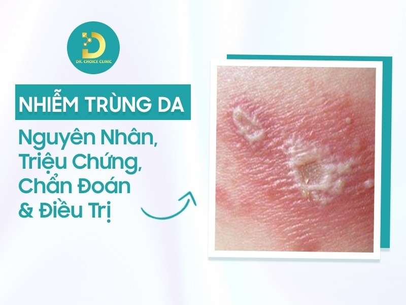 Nhiễm Trùng Da: Nguyên Nhân, Triệu Chứng, Chẩn Đoán & Điều Trị 8 Nhiễm trùng da