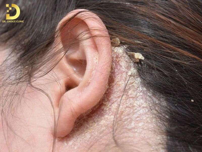 Nấm Da Đầu: Nguyên Nhân, Triệu Chứng & Cách Điều Trị Hiệu Quả 9 Những sai lầm phổ biến khiến bệnh tái phát hoặc diễn tiến nặng