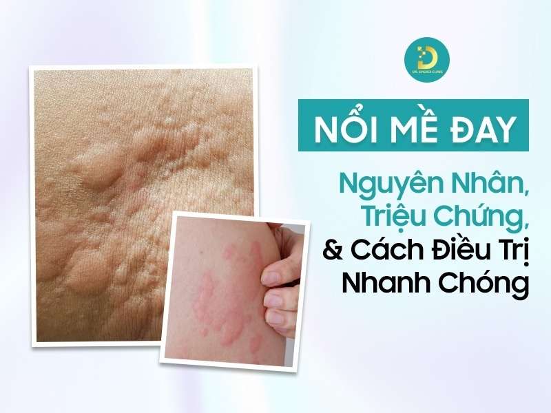 Nổi Mề Đay: Nguyên Nhân, Triệu Chứng & Cách Điều Trị Nhanh Chóng 11 Nổi mề đay