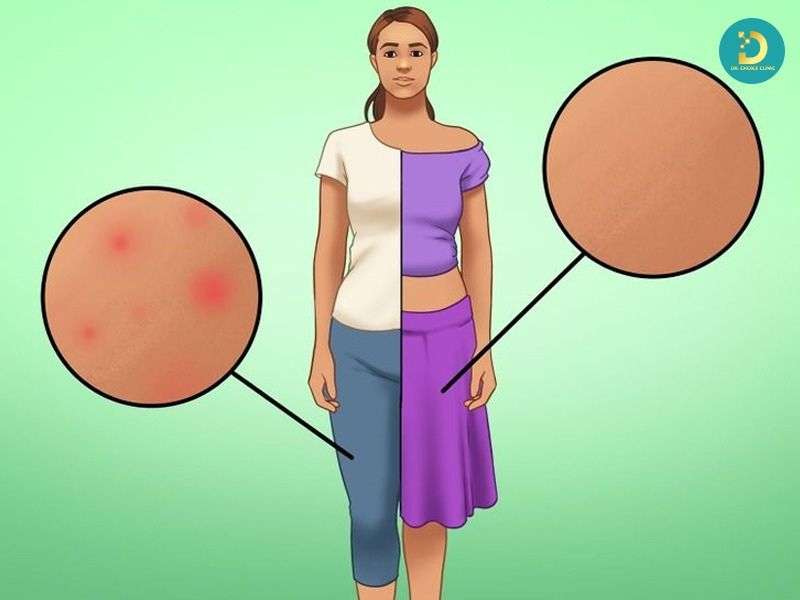 Nổi Mề Đay: Nguyên Nhân, Triệu Chứng & Cách Điều Trị Nhanh Chóng 17 Sai lầm khiến mề đay kéo dài hoặc trở nên nặng hơn