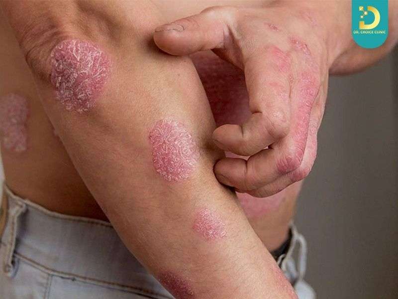 Vảy Nến Có Hết Không? Cách Chăm Sóc & Điều Trị Hiệu Quả Tại Nhà 18 Sai lầm thường gặp khi tự điều trị vảy nến tại nhà