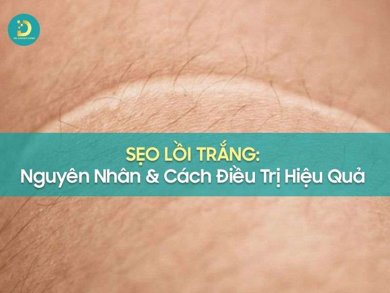 Sẹo Lồi Trắng: Nguyên Nhân & Cách Điều Trị Hiệu Quả 9 Sẹo lồi trắng