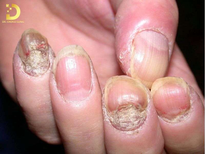 Nấm Móng: Triệu Chứng, Nguyên Nhân & Cách Điều Trị Hiệu Quả 11 Sự chủ quan nguy hiểm ở bệnh nhân tiểu đường