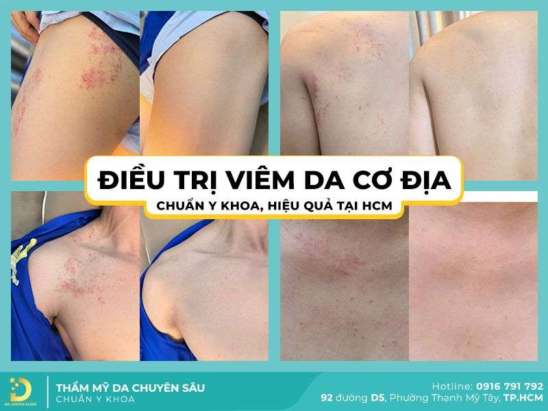 Viêm Da Cơ Địa Bôi Gì, Kiêng Gì? Cách Điều Trị Tại Nhà Hiệu Quả 13 Địa chỉ nào chữa viêm da cơ địa uy tín HCM?