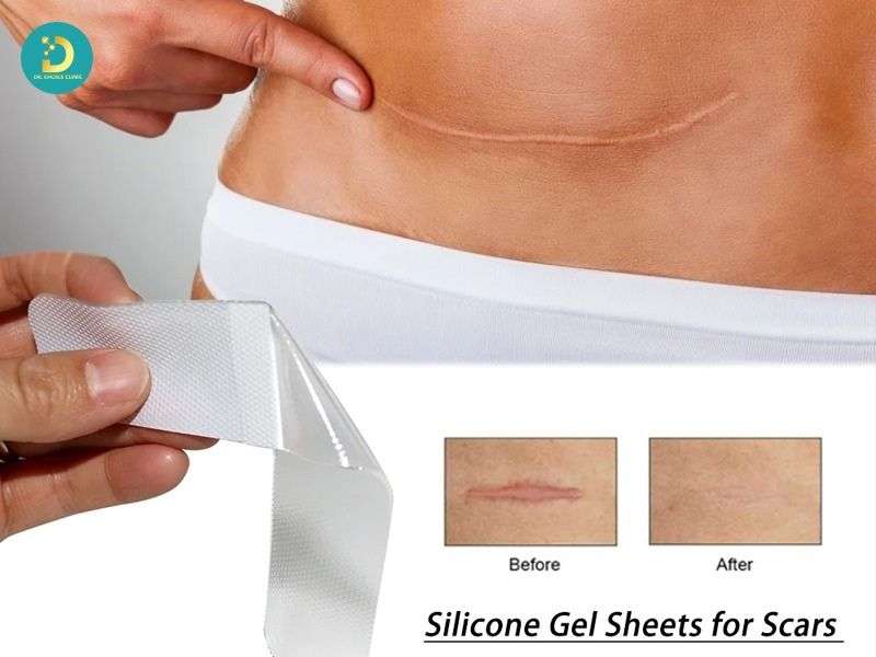 Sản Phẩm Trị Sẹo Lồi: Công Dụng, Hiệu Quả, Các Loại, Có Nên Dùng? 14 Tần suất và thời gian sử dụng cần thiết