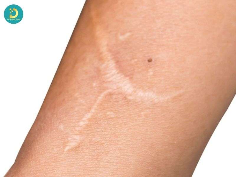 Sẹo Lồi Trắng: Nguyên Nhân & Cách Điều Trị Hiệu Quả 11 Thoái triển tự nhiên ở sẹo lồi lâu năm