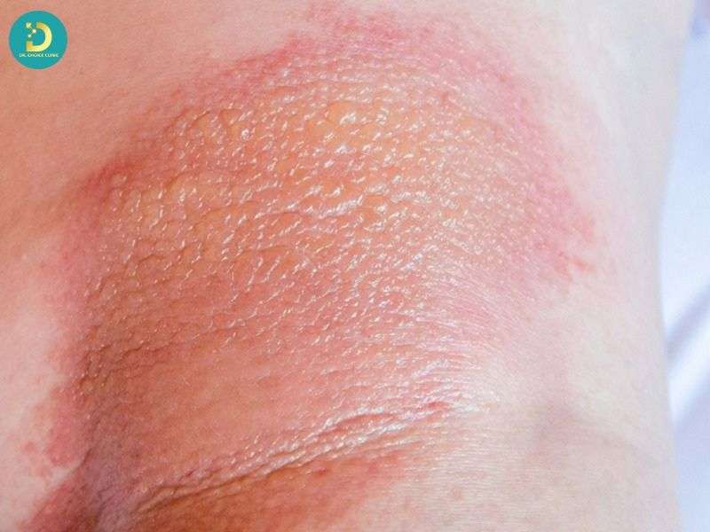 Nhiễm Trùng Da: Nguyên Nhân, Triệu Chứng, Chẩn Đoán & Điều Trị 11 Triệu chứng theo từng mức độ