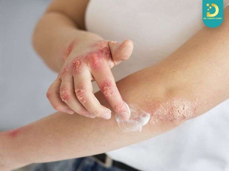 Vảy Nến Có Hết Không? Cách Chăm Sóc & Điều Trị Hiệu Quả Tại Nhà 14 Vảy nến bôi gì để giảm viêm và bong tróc?
