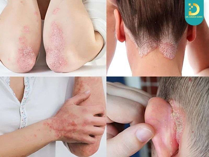 Vảy Nến Có Hết Không? Cách Chăm Sóc & Điều Trị Hiệu Quả Tại Nhà 12 Vảy nến có hết không?