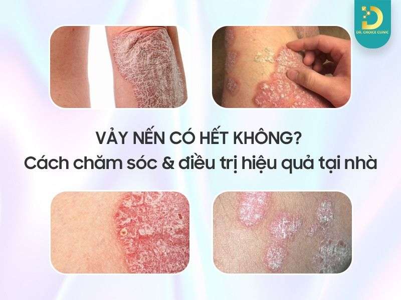 Vảy Nến Có Hết Không? Cách Chăm Sóc & Điều Trị Hiệu Quả Tại Nhà 11 Vảy nến có hết không?