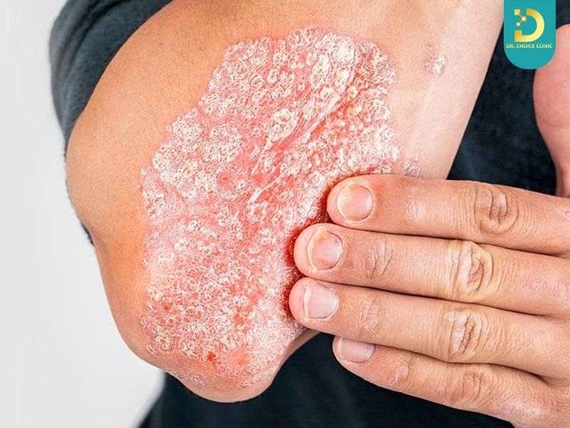 Vảy Nến Có Hết Không? Cách Chăm Sóc & Điều Trị Hiệu Quả Tại Nhà 13 Vảy nến có lan rộng không?