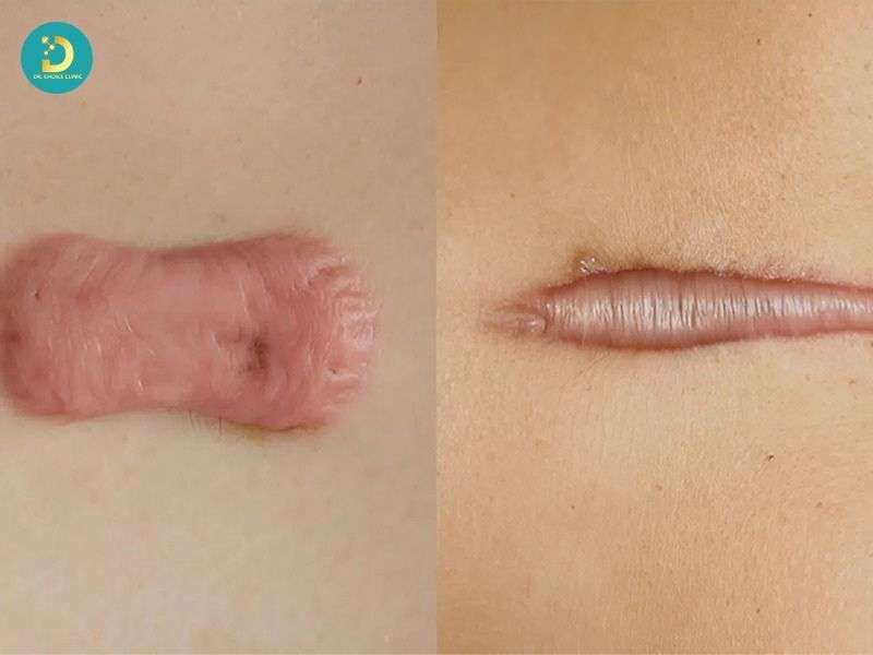 Sản Phẩm Trị Sẹo Lồi: Công Dụng, Hiệu Quả, Các Loại, Có Nên Dùng? 17 Vì sao dùng sản phẩm nhưng sẹo lồi không cải thiện?