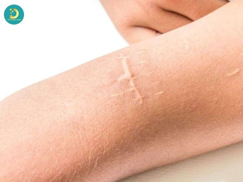Sẹo Lồi Trắng: Nguyên Nhân & Cách Điều Trị Hiệu Quả 10 Vì sao sẹo lồi trắng khó điều trị hơn sẹo lồi đỏ?