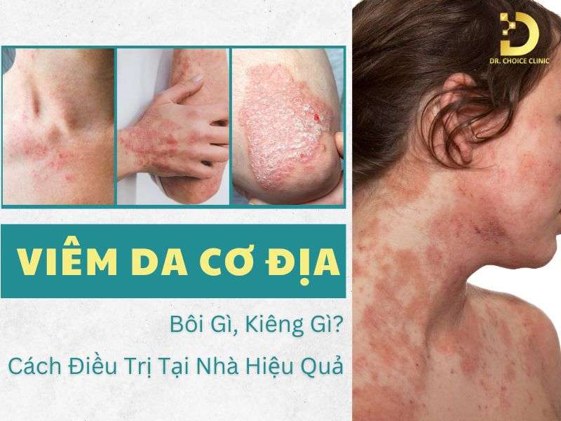 Viêm Da Cơ Địa Bôi Gì, Kiêng Gì? Cách Điều Trị Tại Nhà Hiệu Quả 8 Viêm da cơ địa bôi gì, kiêng gì?