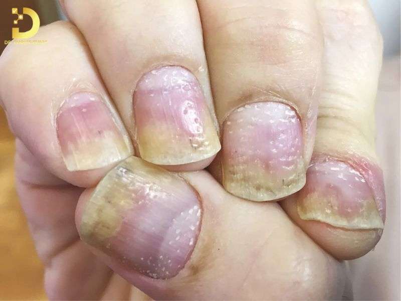 Nấm Móng: Triệu Chứng, Nguyên Nhân & Cách Điều Trị Hiệu Quả 9 Yếu tố nguy cơ và đối tượng dễ bị nấm tấn công nhất