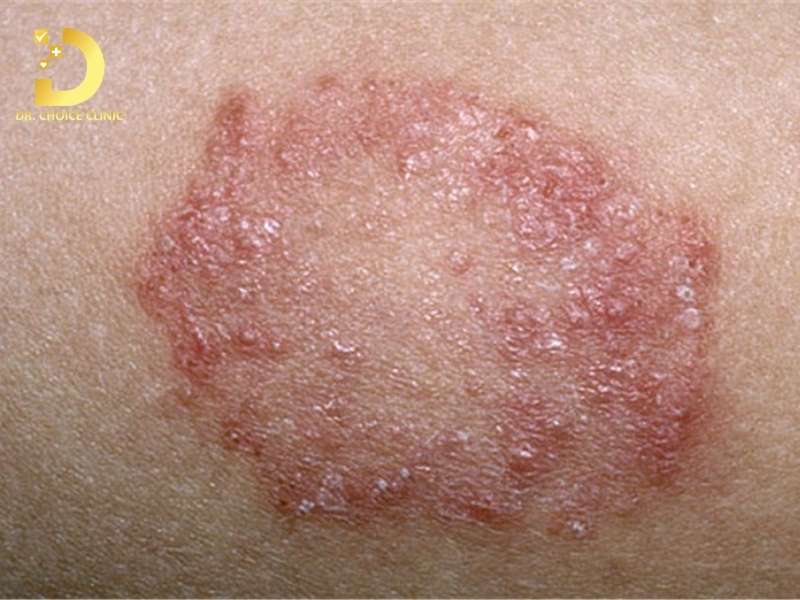 Nấm Thân Mình: Triệu Chứng, Nguyên Nhân & Cách Điều Trị Hiệu Quả 10 Bệnh nấm thân mình là gì? làm thế nào để nhận biết chính xác?