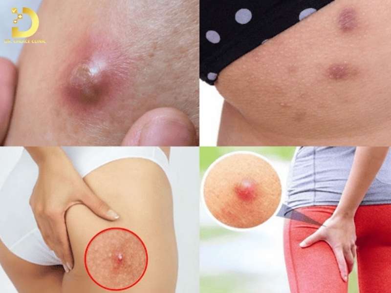 Mụn Ở Mông: Nguyên Nhân & Cách Xử Lý Hiệu Quả Tại Nhà 10 Nhọt và áp xe vùng mông