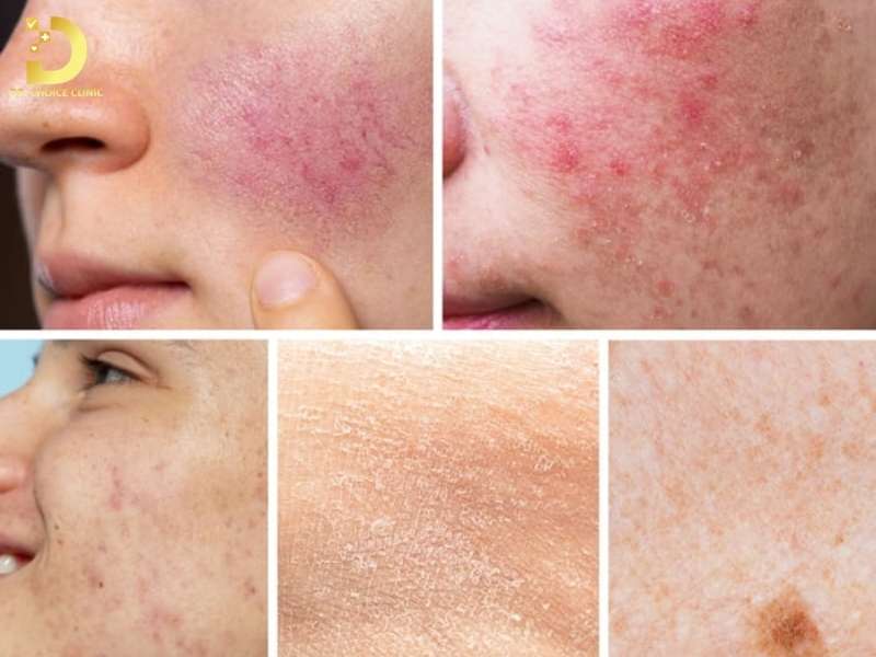 Nấm Da Mặt: Nguyên Nhân, Triệu Chứng & Cách Điều Trị Hiệu Quả 11 Các dạng nấm da mặt thường gặp và cách nhận biết