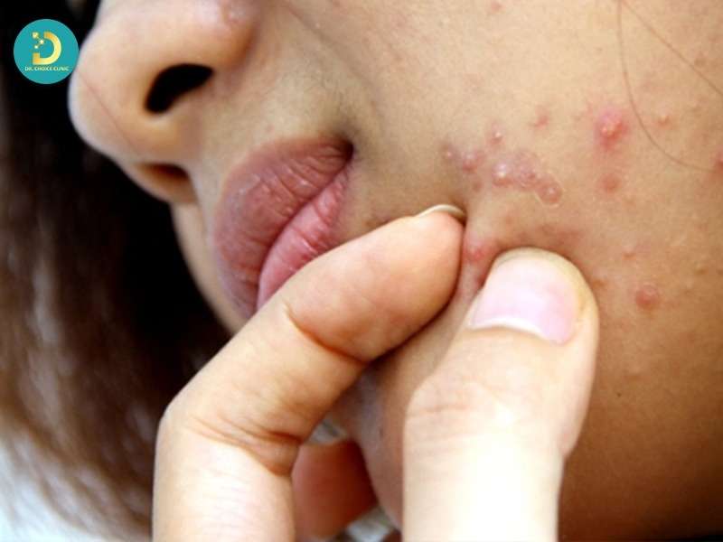 Mụn Ở Tuổi Dậy Thì: Đặc Điểm, Nguyên Nhân Và Cách Điều Trị 17 Các yếu tố làm mụn nặng hơn và kéo dài bệnh