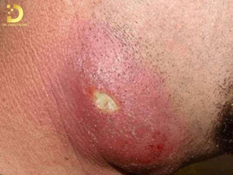 Mụn Viêm Là Gì? Nguyên Nhân, Phân Loại & Cách Điều Trị Hiệu Quả 13 Có bao nhiêu loại mụn viêm thường gặp trên da?