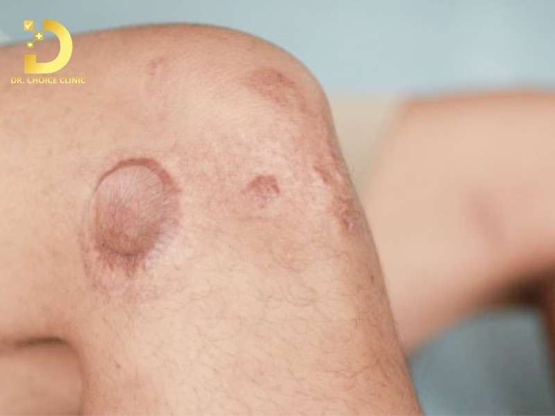 Sẹo Lồi Ở Đầu Gối: Nguyên Nhân & Cách Điều Trị Hiệu Quả 11 Cơ chế hình thành sẹo lồi ở vùng đầu gối như thế nào?