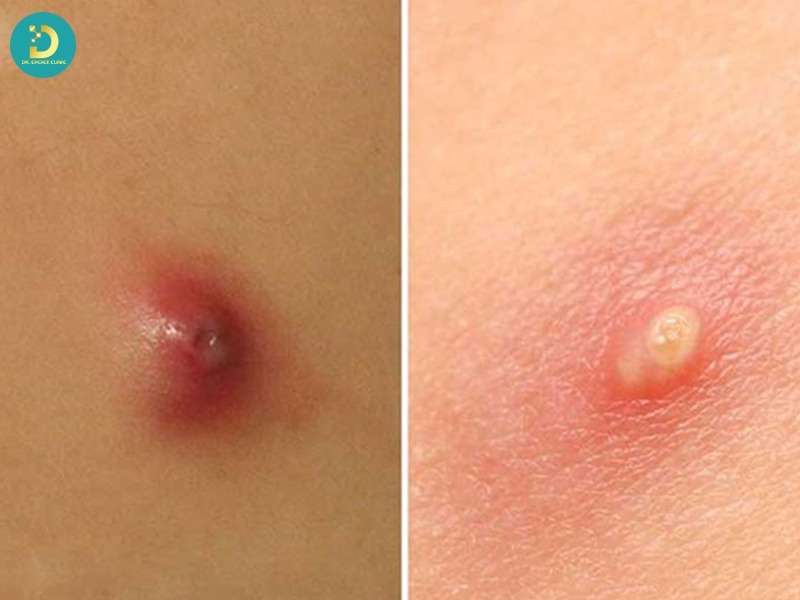 Mụn Mủ Hình Thành Do Đâu? Top Cách Điều Trị Hiệu Quả 16 Cơ chế sinh học của mụn mủ