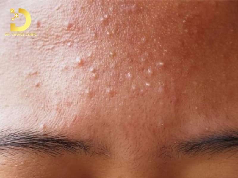 Mụn Không Viêm: Phân Loại, Nguyên Nhân & Cách Điều Trị 11 Cơ chế sinh học nào dẫn đến sự hình thành mụn không viêm?
