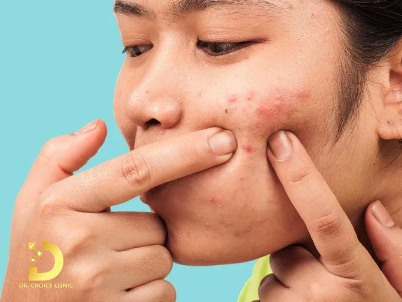 Mụn Viêm Đỏ Có Nên Nặn Không? Cách Điều Trị Tại Nhà Hiệu Quả 11 Có nên nặn mụn viêm đỏ không?