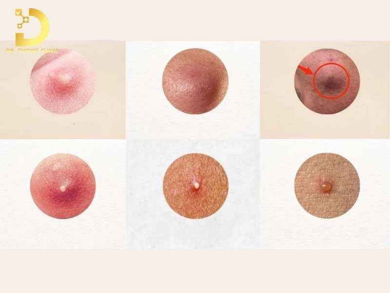 Mụn Bọc Là Gì? Nguyên Nhân, Các Loại Và Cách Điều Trị Hiệu Quả 10 Có những dạng mụn bọc biến thể nào thường gặp trên thực tế?