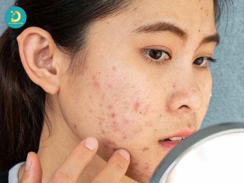 Mụn Ở Tuổi Dậy Thì: Đặc Điểm, Nguyên Nhân Và Cách Điều Trị 14 Đặc điểm và phân loại mụn ở tuổi dậy thì