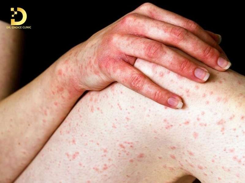 Viêm Da Kích Ứng: Nguyên Nhân, Triệu Chứng, Cách Phòng Ngừa & Điều Trị 9 Dấu hiệu nhận biết viêm da kích ứng và phân biệt với các bệnh da liễu khác là gì?